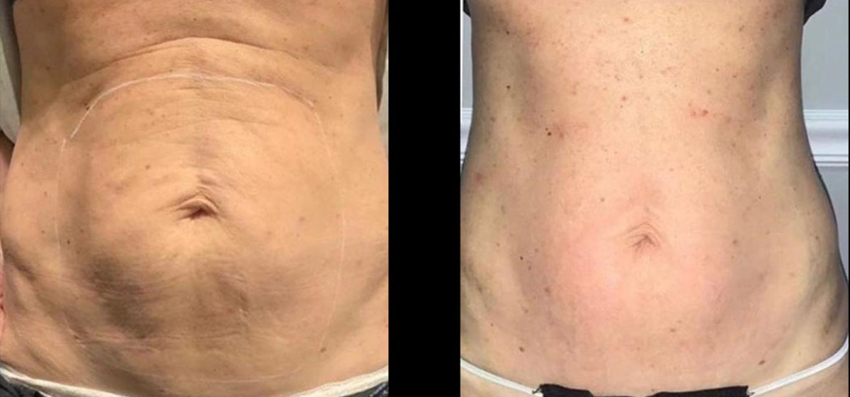 Не хирургическая подтяжка живота BodyTite фото до после