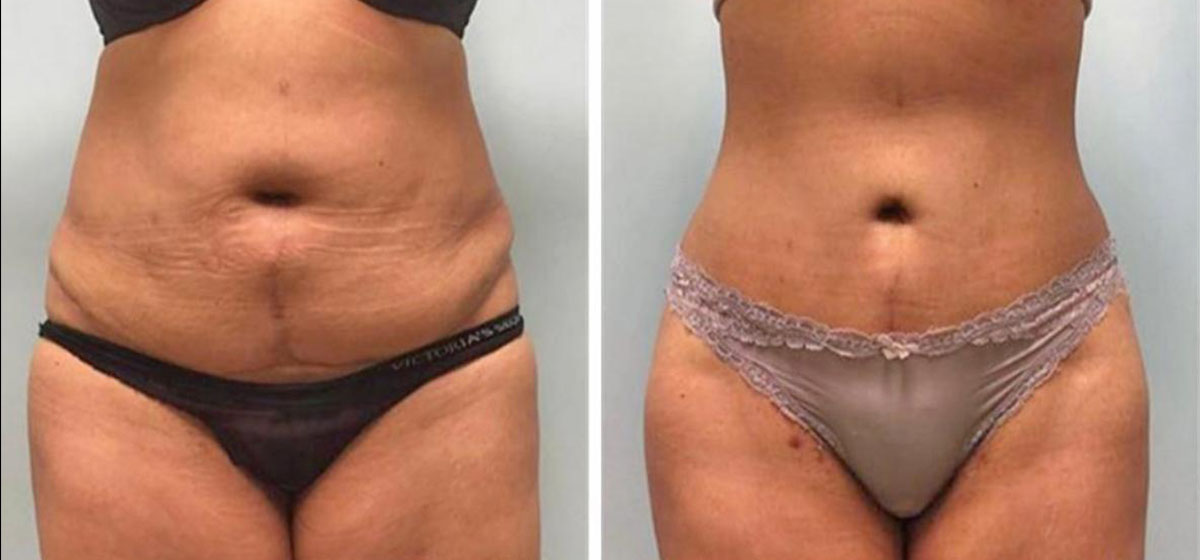 Не хирургическая подтяжка живота BodyTite фото до после