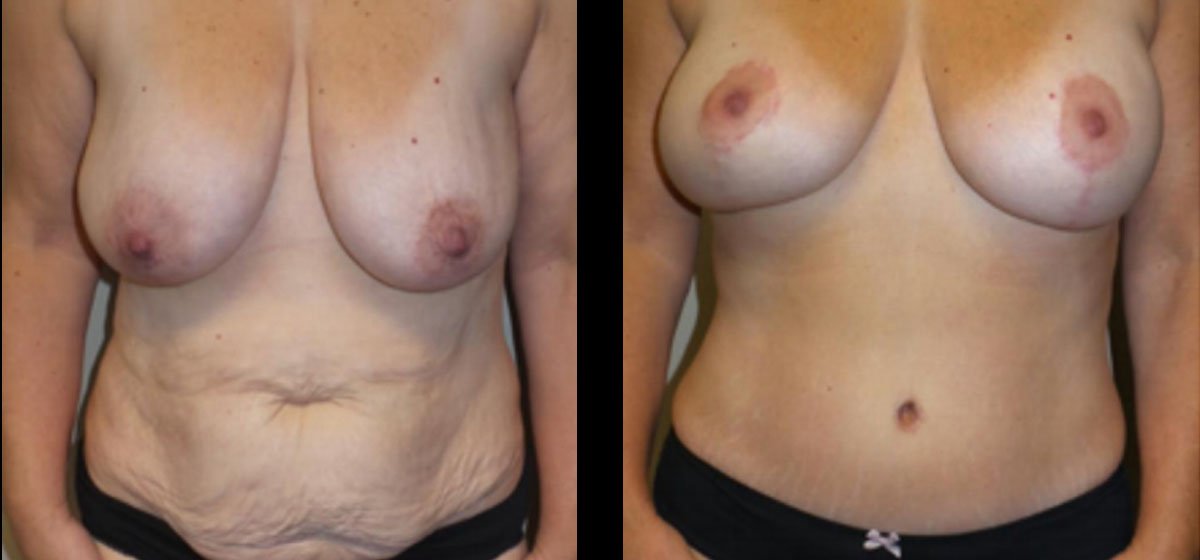 mommy makeover фото до и после