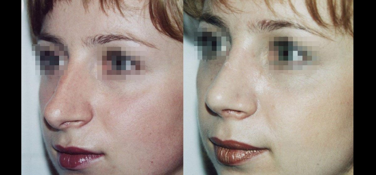 ринопластика фото до после