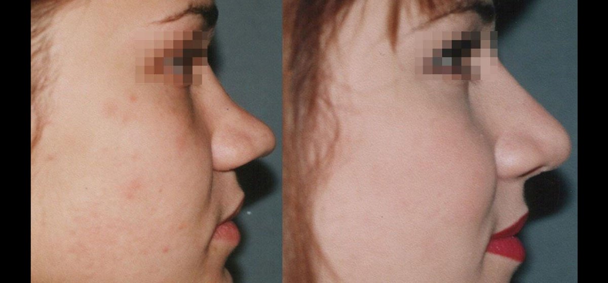 ринопластика фото до после