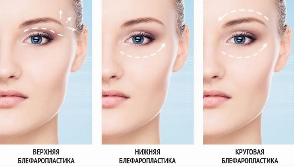 блефаропластика виды